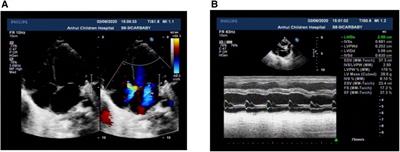 Case Report: Mutation in TNNI3(c. 544G>A): a novel likely pathogenic mechanism of neonatal dilated cardiomyopathy